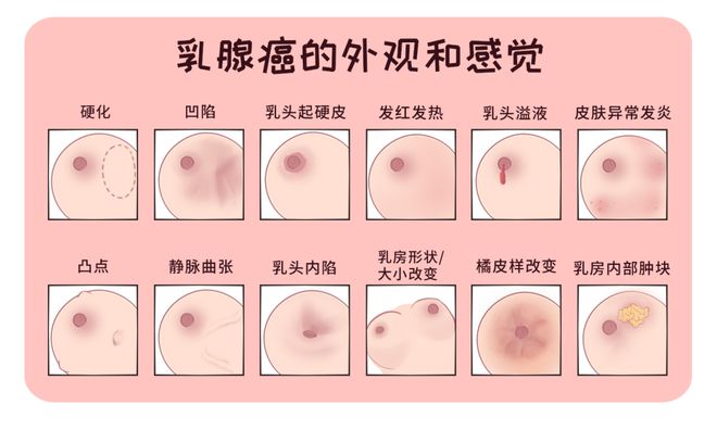 36岁女子乳腺癌早期发现，提醒女性关注乳腺健康的重要性